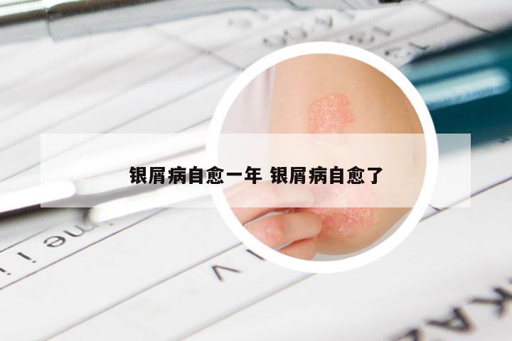 银屑病自愈一年 银屑病自愈了