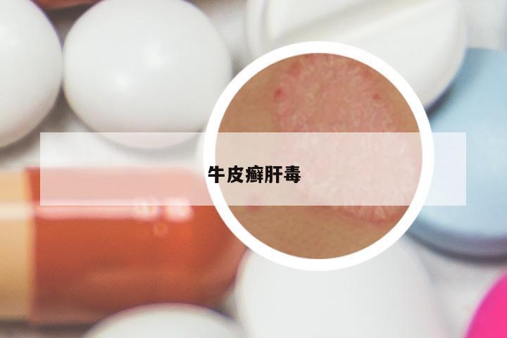 牛皮癣肝毒
