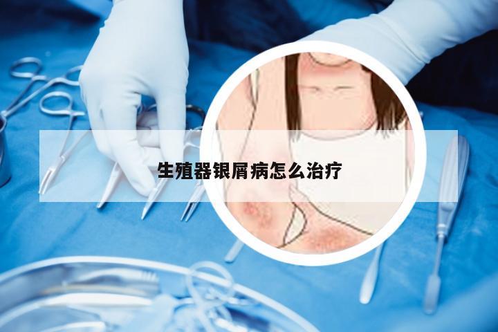 生殖器银屑病怎么治疗