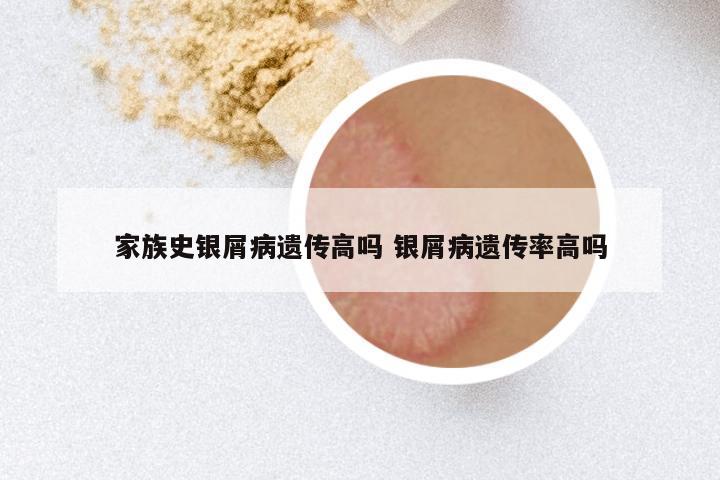 家族史银屑病遗传高吗 银屑病遗传率高吗