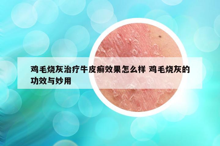 鸡毛烧灰治疗牛皮癣效果怎么样 鸡毛烧灰的功效与妙用