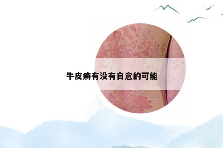 牛皮癣有没有自愈的可能