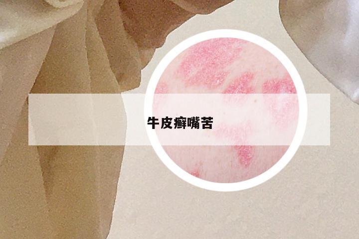 牛皮癣嘴苦