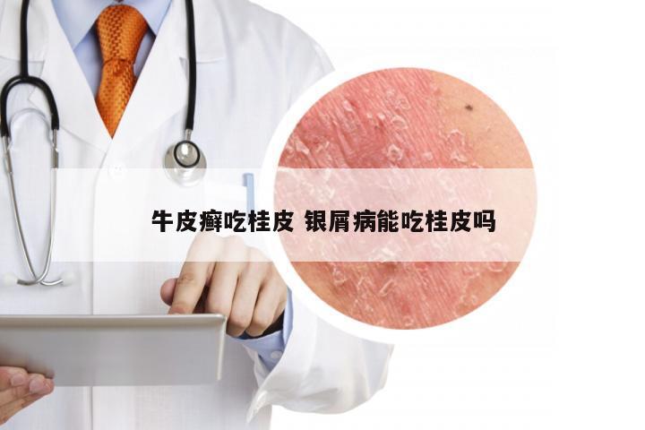 牛皮癣吃桂皮 银屑病能吃桂皮吗