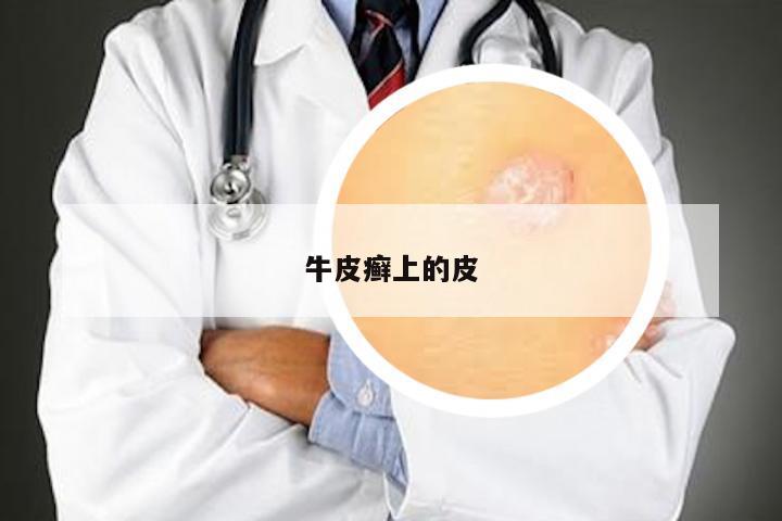 牛皮癣上的皮