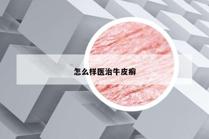怎么样医治牛皮癣