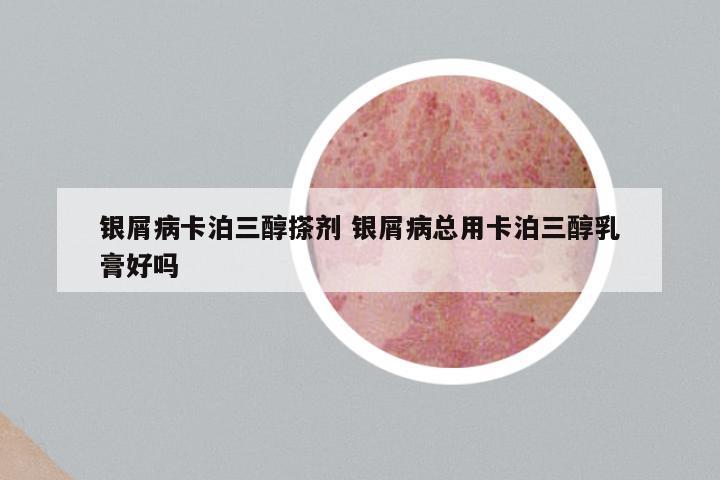 银屑病卡泊三醇搽剂 银屑病总用卡泊三醇乳膏好吗