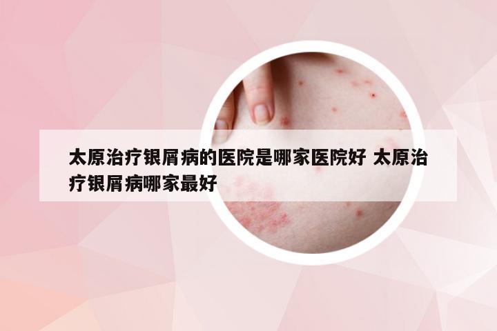 太原治疗银屑病的医院是哪家医院好 太原治疗银屑病哪家最好