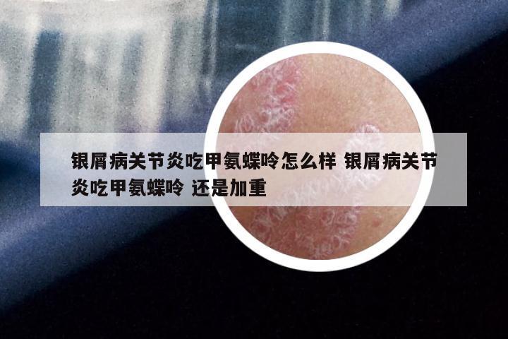 银屑病关节炎吃甲氨蝶呤怎么样 银屑病关节炎吃甲氨蝶呤 还是加重