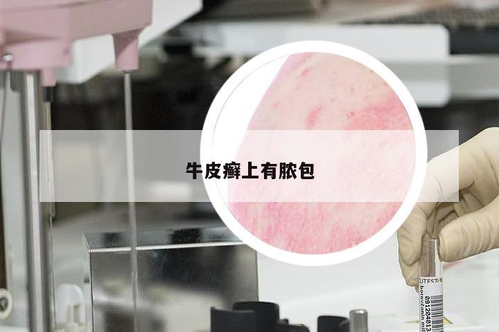 牛皮癣上有脓包