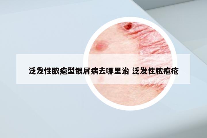 泛发性脓疱型银屑病去哪里治 泛发性脓疱疮