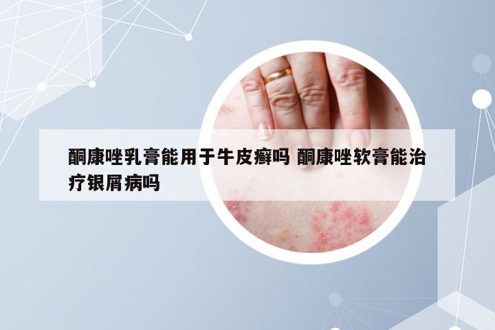 酮康唑乳膏能用于牛皮癣吗 酮康唑软膏能治疗银屑病吗
