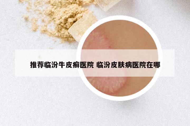 推荐临汾牛皮癣医院 临汾皮肤病医院在哪