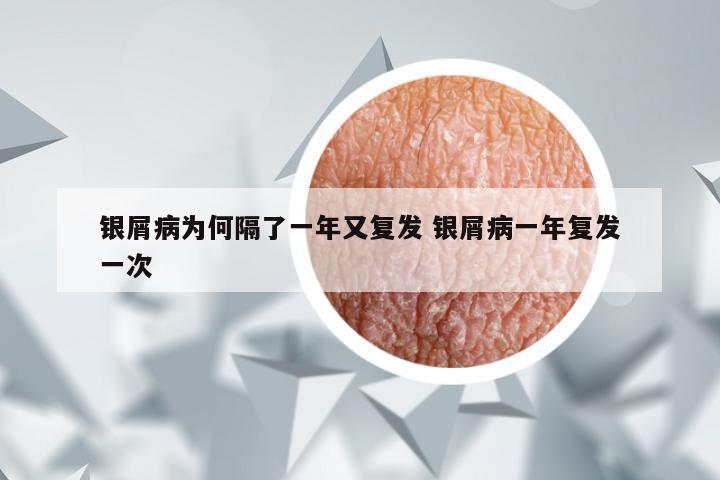 银屑病为何隔了一年又复发 银屑病一年复发一次