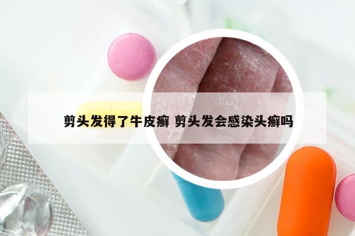 剪头发得了牛皮癣 剪头发会感染头癣吗