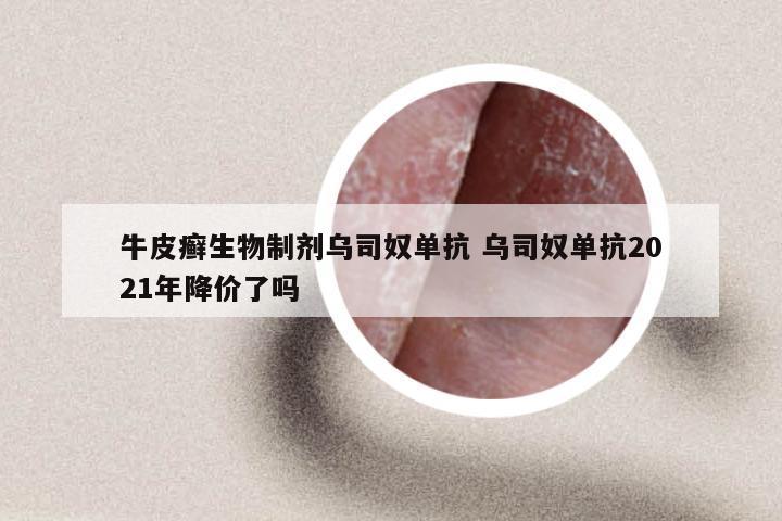 牛皮癣生物制剂乌司奴单抗 乌司奴单抗2021年降价了吗