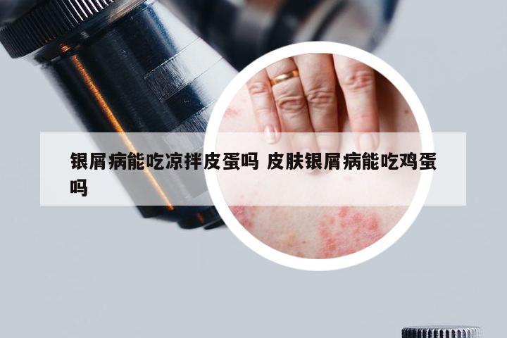 银屑病能吃凉拌皮蛋吗 皮肤银屑病能吃鸡蛋吗