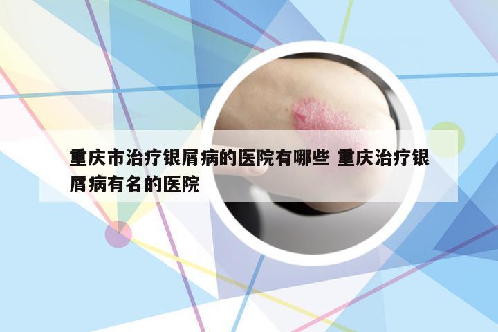 重庆市治疗银屑病的医院有哪些 重庆治疗银屑病有名的医院