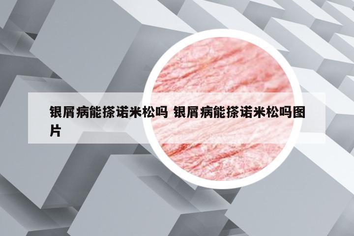 银屑病能搽诺米松吗 银屑病能搽诺米松吗图片