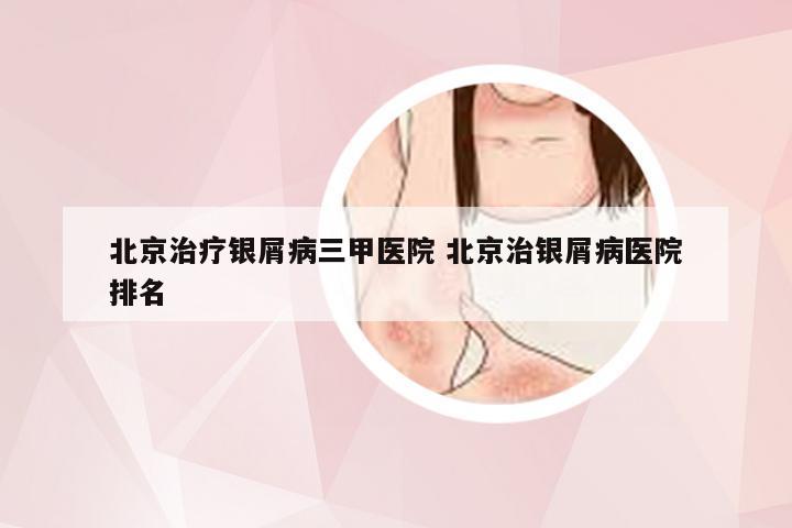 北京治疗银屑病三甲医院 北京治银屑病医院排名