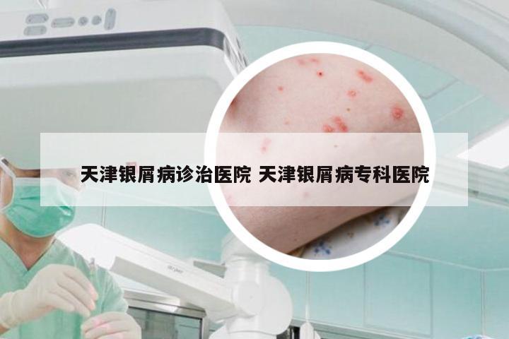 天津银屑病诊治医院 天津银屑病专科医院
