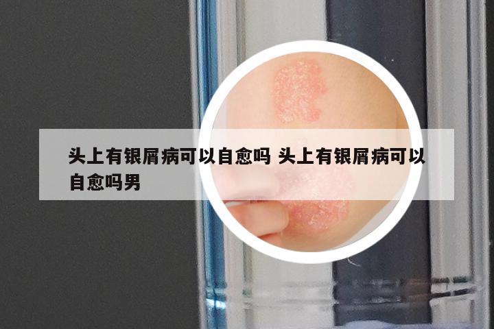头上有银屑病可以自愈吗 头上有银屑病可以自愈吗男