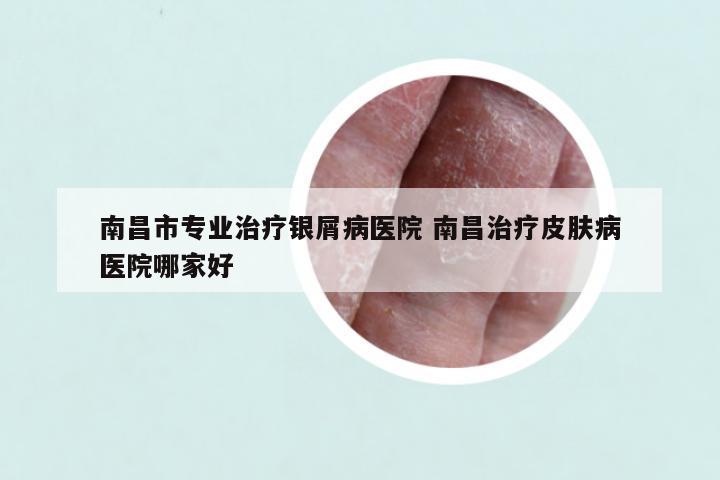 南昌市专业治疗银屑病医院 南昌治疗皮肤病医院哪家好