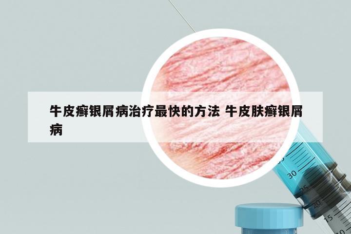牛皮癣银屑病治疗最快的方法 牛皮肤癣银屑病