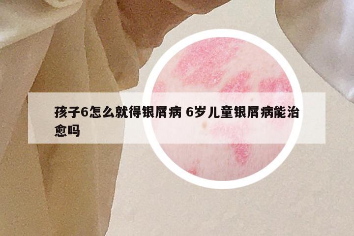 孩子6怎么就得银屑病 6岁儿童银屑病能治愈吗