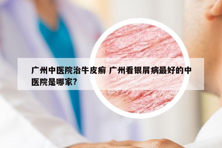 广州中医院治牛皮癣 广州看银屑病最好的中医院是哪家?