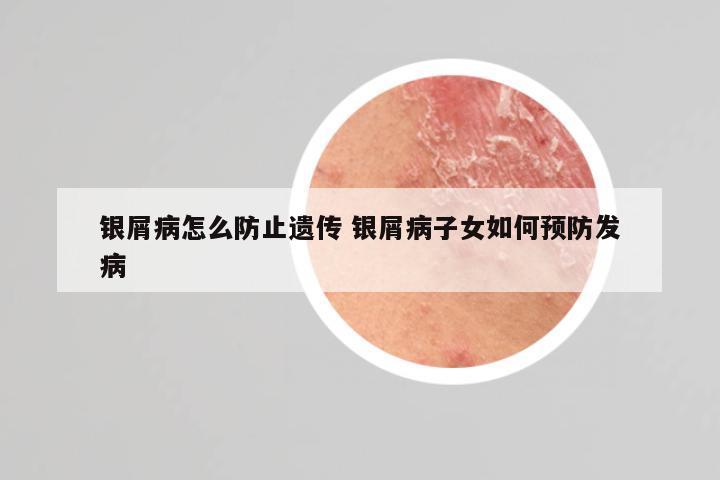 银屑病怎么防止遗传 银屑病子女如何预防发病