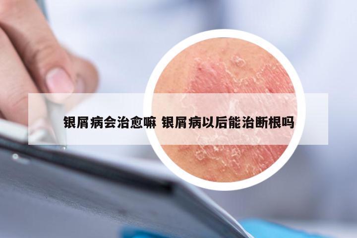 银屑病会治愈嘛 银屑病以后能治断根吗