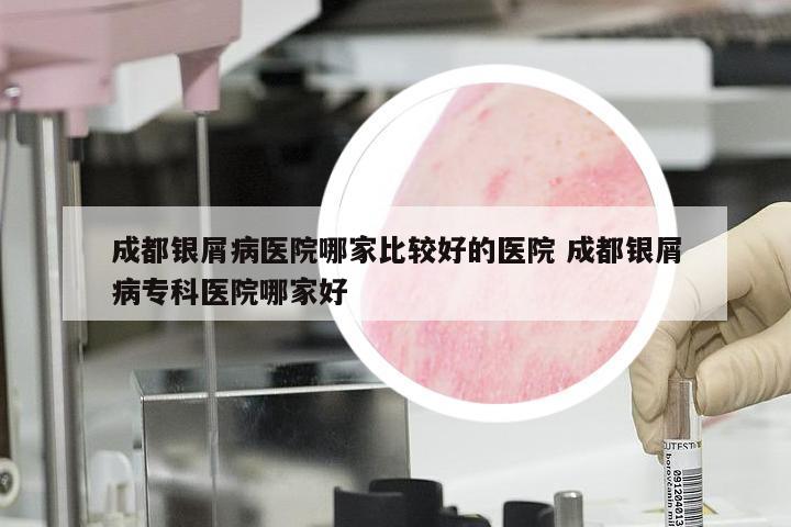 成都银屑病医院哪家比较好的医院 成都银屑病专科医院哪家好