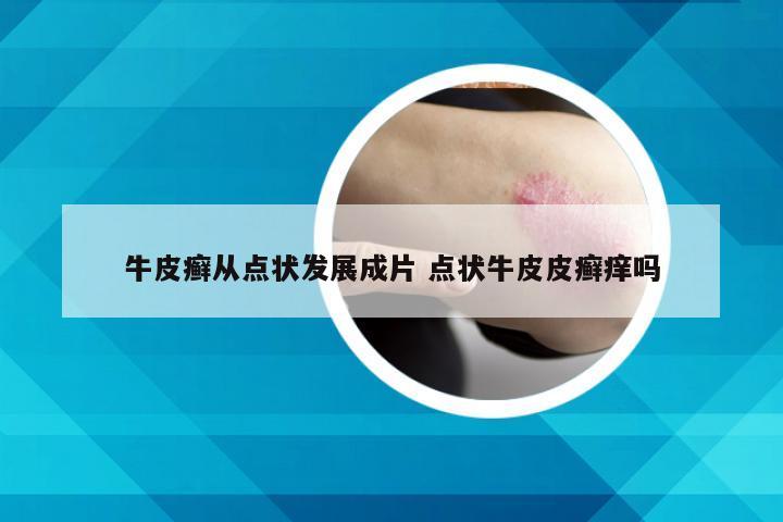 牛皮癣从点状发展成片 点状牛皮皮癣痒吗