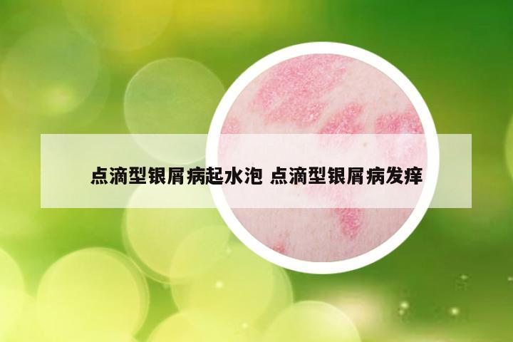 点滴型银屑病起水泡 点滴型银屑病发痒