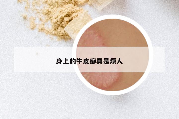 身上的牛皮癣真是烦人