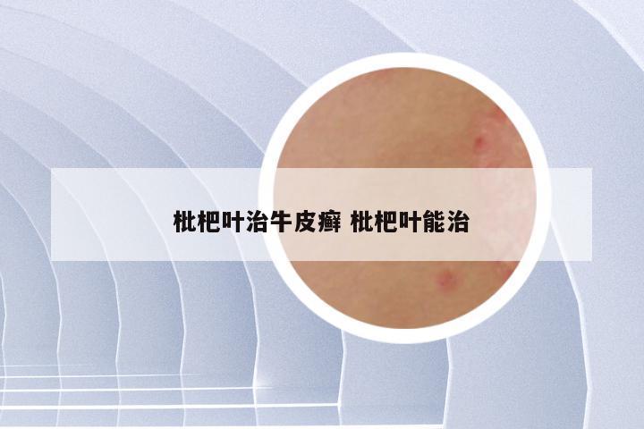 枇杷叶治牛皮癣 枇杷叶能治