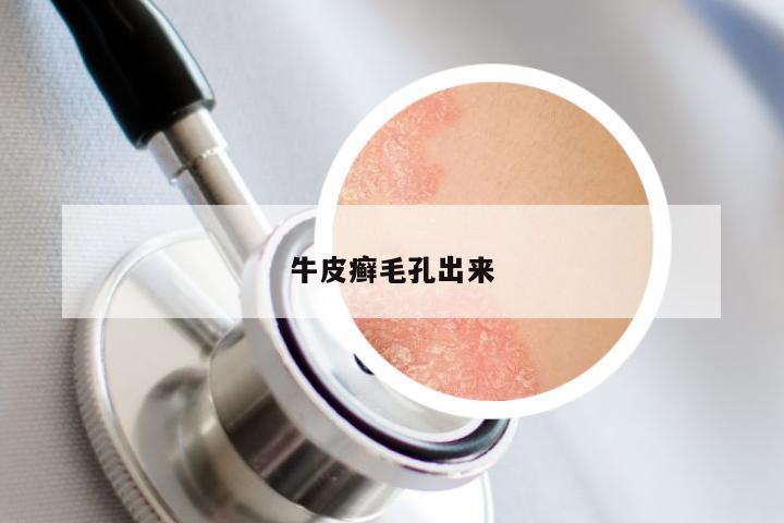 牛皮癣毛孔出来