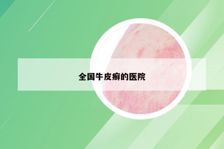 全国牛皮癣的医院