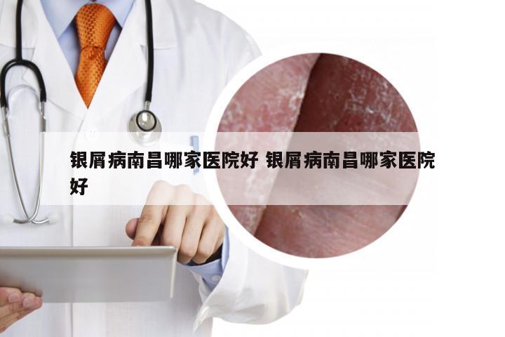银屑病南昌哪家医院好 银屑病南昌哪家医院好