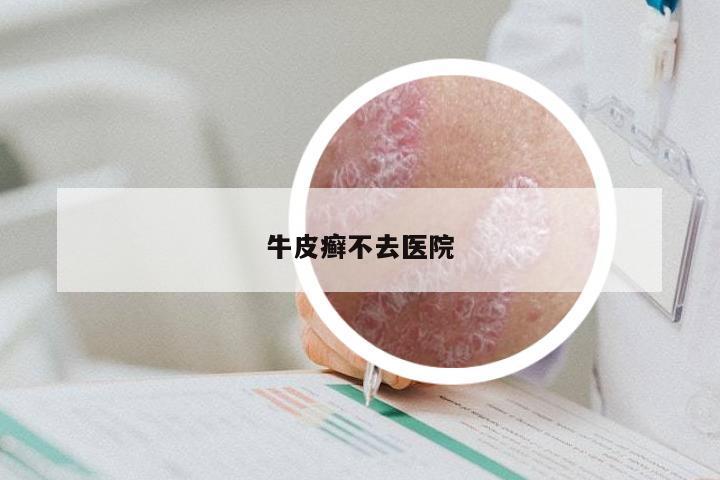 牛皮癣不去医院