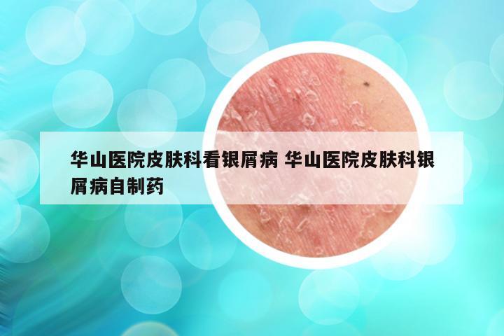 华山医院皮肤科看银屑病 华山医院皮肤科银屑病自制药