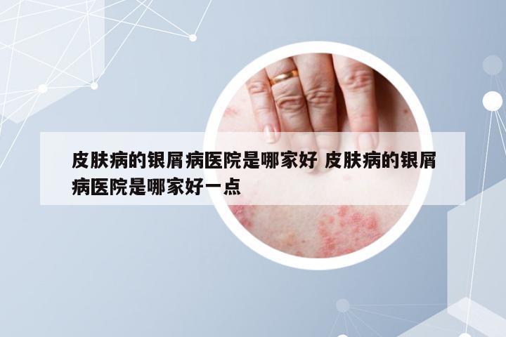 皮肤病的银屑病医院是哪家好 皮肤病的银屑病医院是哪家好一点