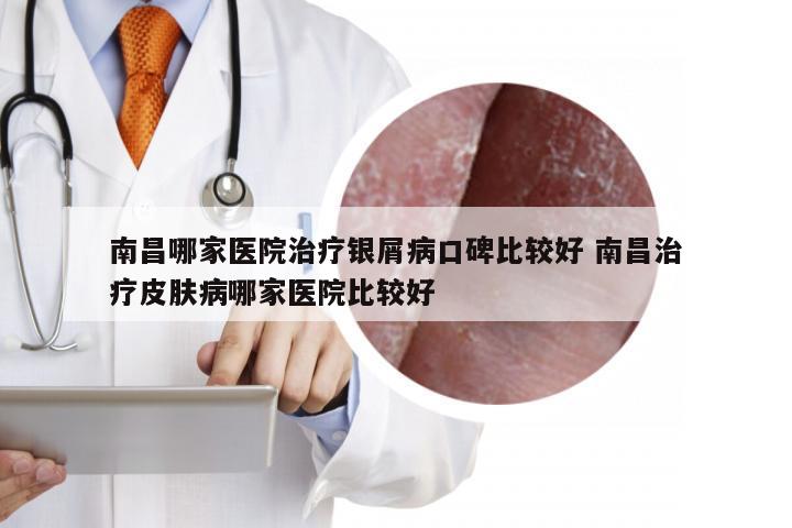 南昌哪家医院治疗银屑病口碑比较好 南昌治疗皮肤病哪家医院比较好