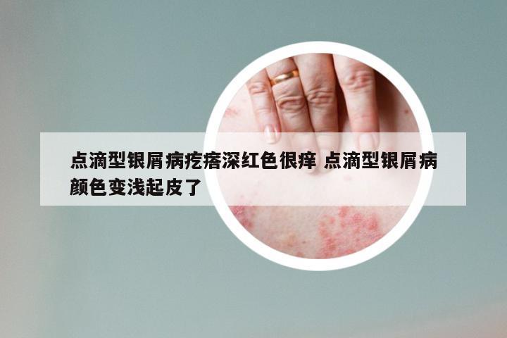 点滴型银屑病疙瘩深红色很痒 点滴型银屑病颜色变浅起皮了