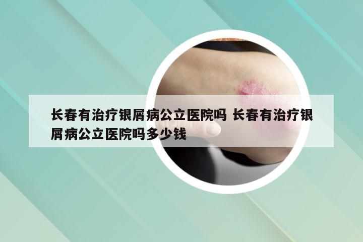 长春有治疗银屑病公立医院吗 长春有治疗银屑病公立医院吗多少钱