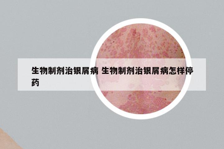 生物制剂治银屑病 生物制剂治银屑病怎样停药