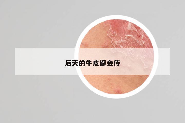 后天的牛皮癣会传