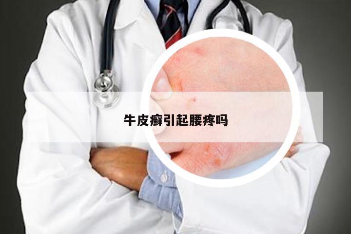 牛皮癣引起腰疼吗