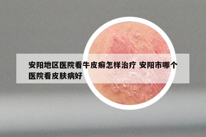 安阳地区医院看牛皮癣怎样治疗 安阳市哪个医院看皮肤病好